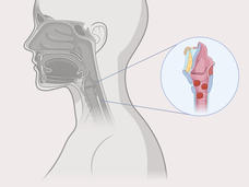 Gene therapy shows clinical benefit in patients with a debilitating disorder caused by HPV